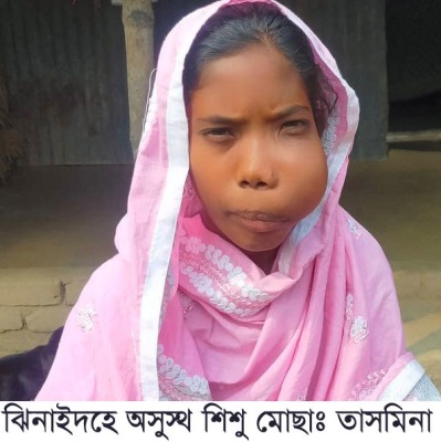মুখে বড় টিউমার নিয়ে বসবাস শিশু তাসমিনার