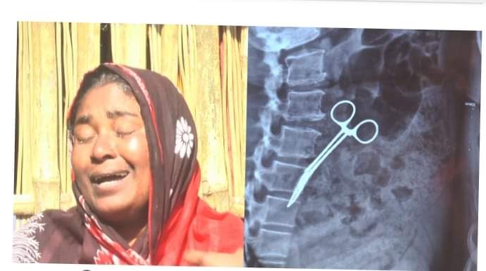 ২০ বছর পর রোগীর পেটে মিলল কাঁচি