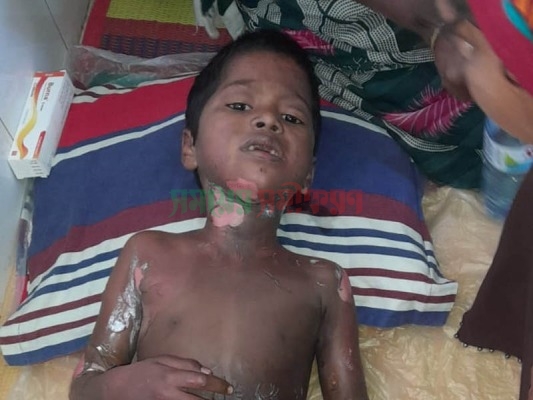 দামুড়হুদায় আলু ভাজি করতে যেয়ে শিশু আগুনে দগ্ধ!