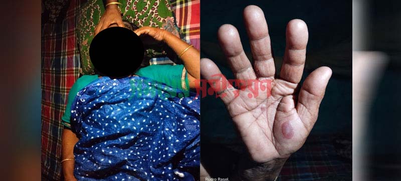 চুয়াডাঙ্গায় মাঙ্কিপক্স উপসর্গের এক রোগী শনাক্ত