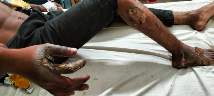 আলমডাঙ্গায় বিদ্যুৎস্পৃষ্ট হয়ে দুই যুবক দগ্ধ